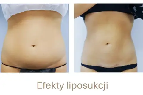 Po liposukcji tłuszcz wraca? Nie! Jak utrzymać nową sylwetkę