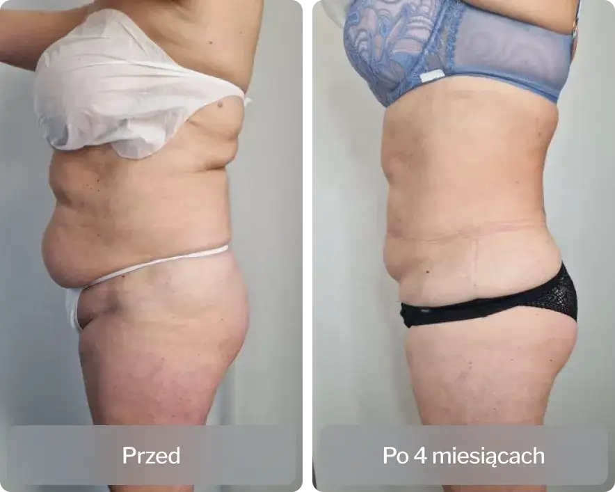 Liposukcja ultradźwiękowa schemat działania i harmonogram zabieg&oacute;w